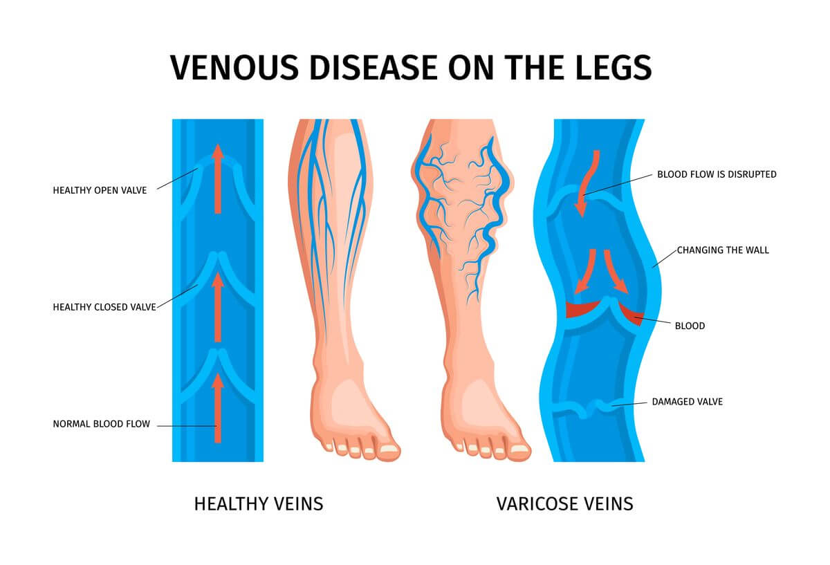 https://nexgen.vfdevserver.com/wp-content/uploads/2023/03/varicose-veins-anatomy-infographics-1.jpg